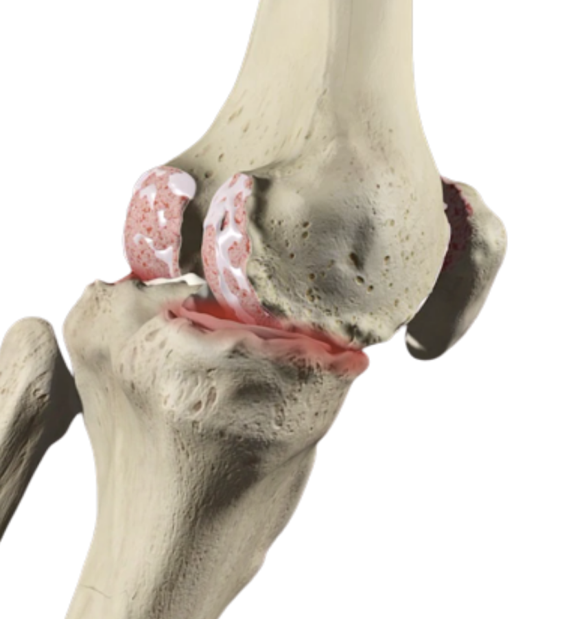 Osteoartrosis primaria y secundaria